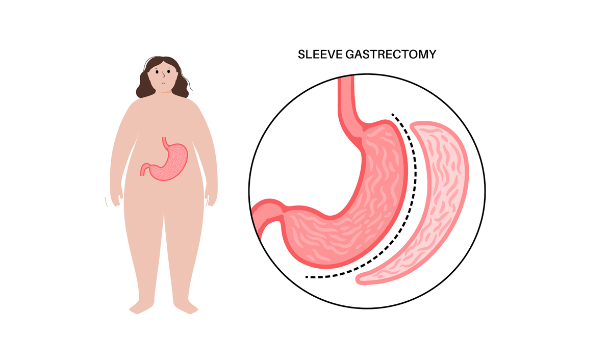 https://ahmetziyabalta.com/wp-content/uploads/2025/05/Sleeve-Gastrectomy.jpg