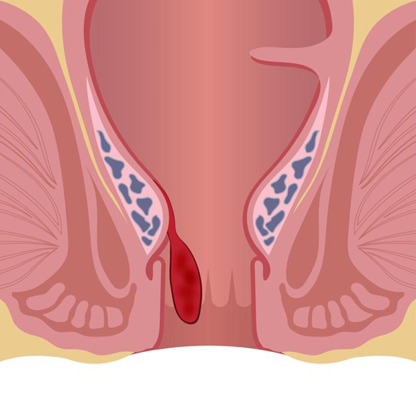 Makatta Kanama Neden Olur? Belirtileri, Nedenleri ve Tedavi Yöntemleri