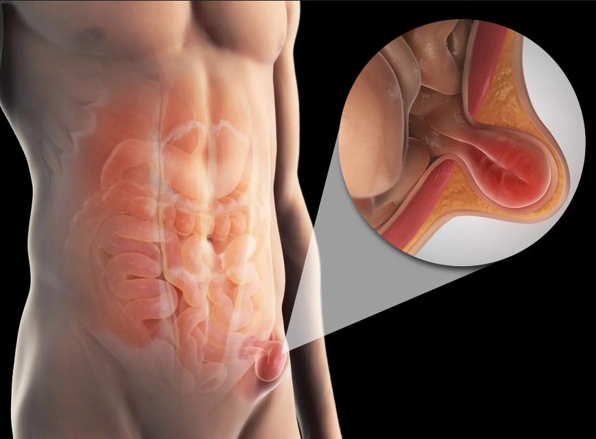 Kasık Fıtığı Nedir? Belirtileri ve Tedavisi