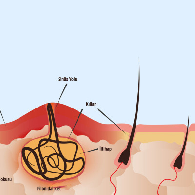 Kıl Dönmesi Ameliyatı Lazerle Nasıl Yapılır?
