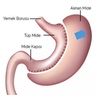 Obezite Cerrahisi Nedir? Tüp Mide ve Gastrik Bypass ile Kalıcı Kilo Verme