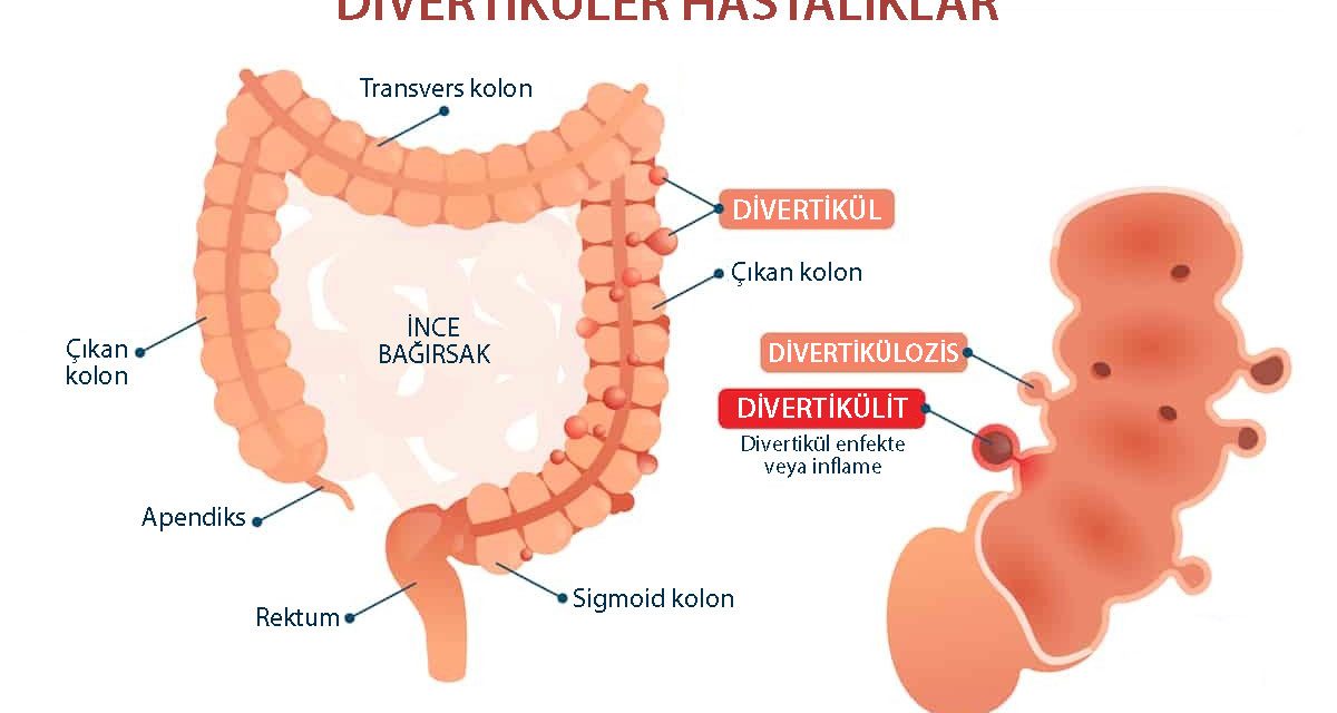 Divertiküler Hastalık Nedir? Belirtileri, Tedavisi ve Ameliyatı | Prof. Dr. Ahmet Ziya Balta